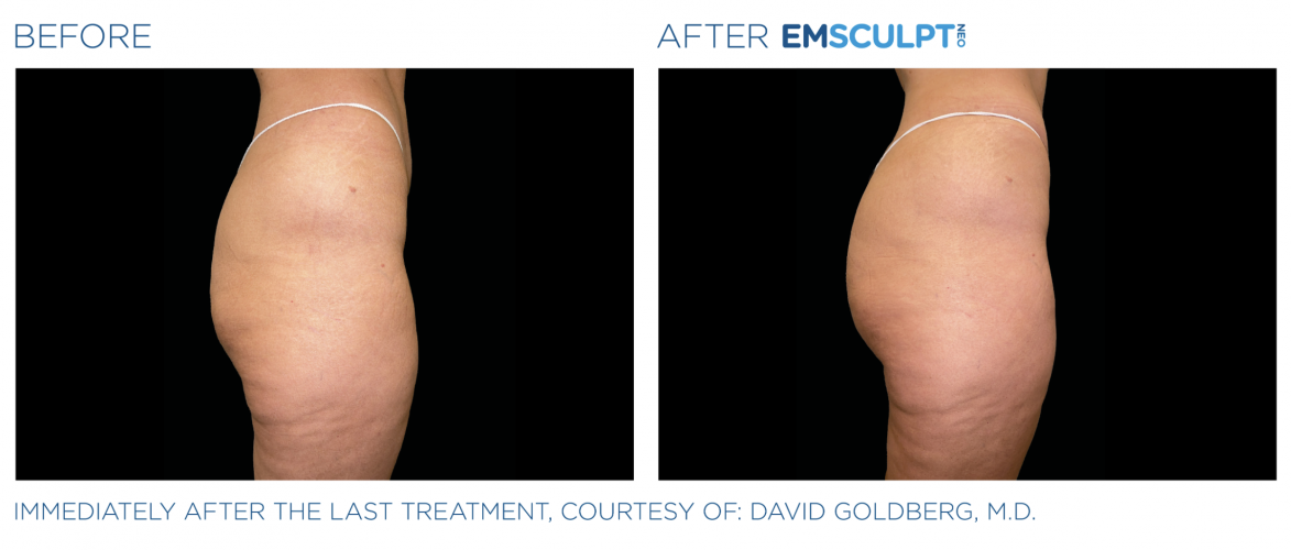 Emsculpt in Minnetonka MN