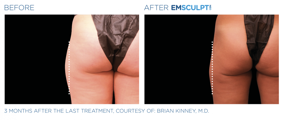 Non-Surgical Body Sculpting Solutions