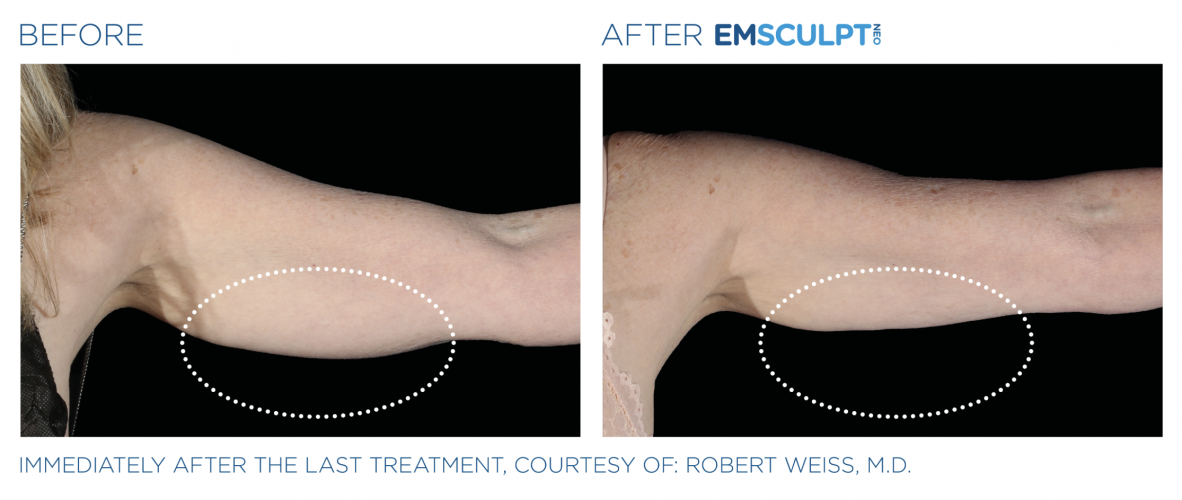 Natural Non Surgical Fat Loss Solution in Minnetonka